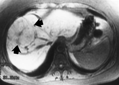 Ct And Mr Imaging Of Benign Hepatic And Biliary Tumors Radiographics