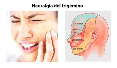 Neuralgia del trigémino