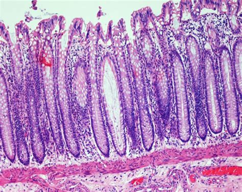 PC1 Pathology Of Gut Flashcards Quizlet