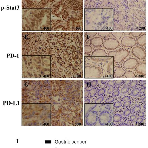 Expression Of Il 6 P Stat3 Pd 1 And Pd L1 In Gc And Paracancerous