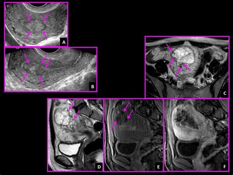 Complete Hydatidiform Mole In A 26 Year Old Woman Transversal A And