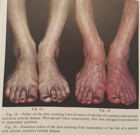 Pulse Examination Of The Lower Extremity Vascular Medicine