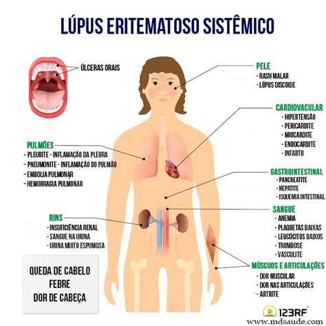 L Pus Eritematoso Sist Mico Sintomas E Tratamento Md Sa De