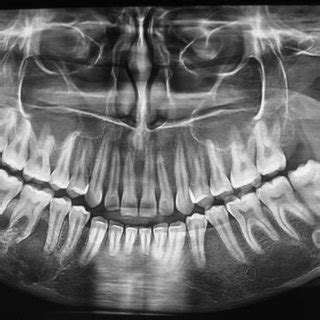 Orthopantomogram Revealing Multilocular Radiolucency In The Right Side