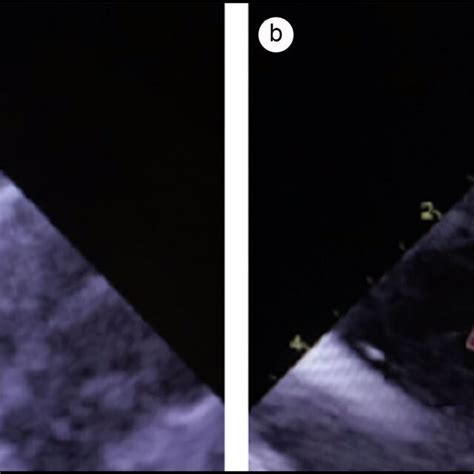 Color Doppler Echocardiography A Preoperative Image Showing