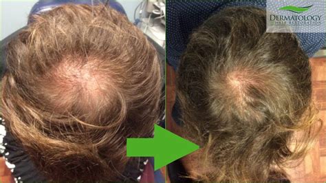 Does A Dermatologist Treat Hair Loss Great Group Day By Day Account