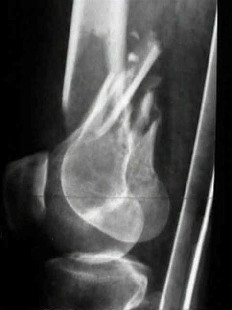 Supracondylar Femoral Fractures Wheeless Textbook Of Orthopaedics