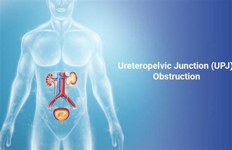 An Overview of Ureteropelvic Junction (UPJ) Obstruction