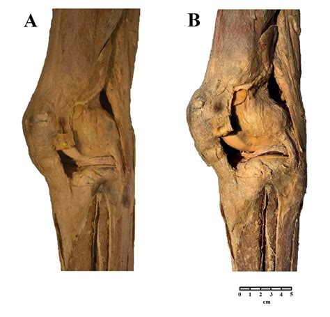 Plastination Of Glycerin Fixed Specimens The Journal Of Plastination