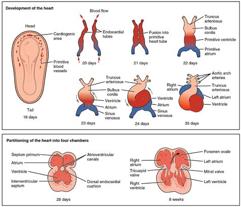 Tetralogy Of Fallot Pathophysiology Wikidoc