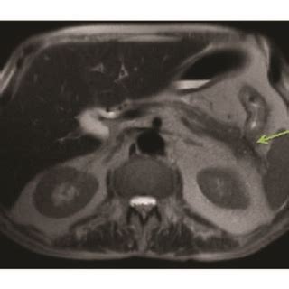 MRCP Showing Cystic Foci In The Pancreatic Tail And Colonic Wall