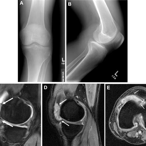 E A 62 Year Old Man With Bilateral Pigmented Villonodular Synovitis Of