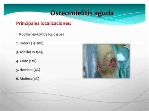 Osteomielitis Aguda