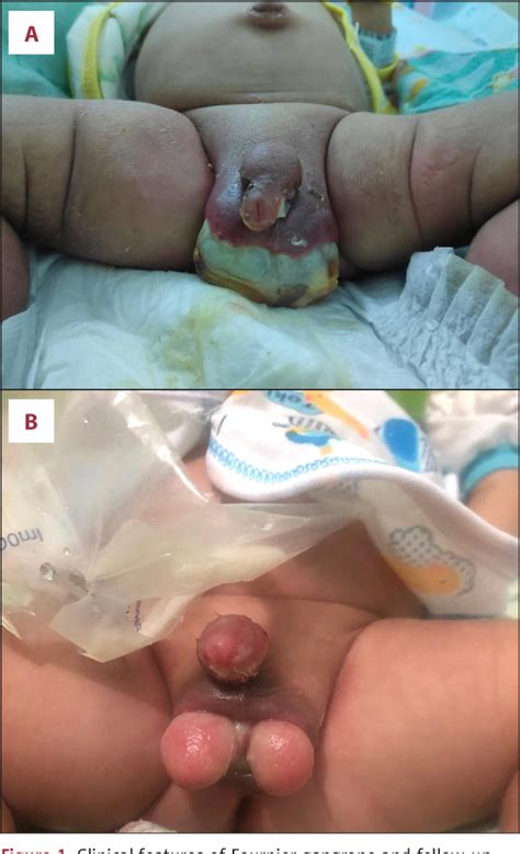 Neonatal Scrotal Wall Necrotizing Fasciitis Fournier Gangrene A Case