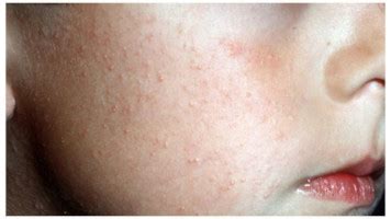 Follicular keratosis - причины, сиптомы, лечение- MyAllergo