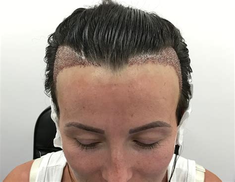 Female Hair Transplant Hair Loss Treatment For Women