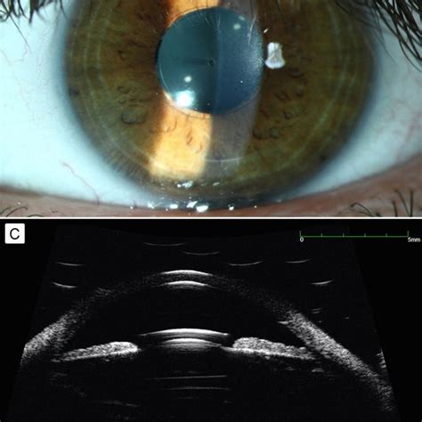 A Posterior Chamber Collamer Phakic Intraocular Lens RSK 3 S