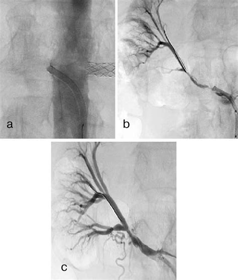 Female Patient Sh Right Renal Arteriograms а Occluded Right Renal Download Scientific