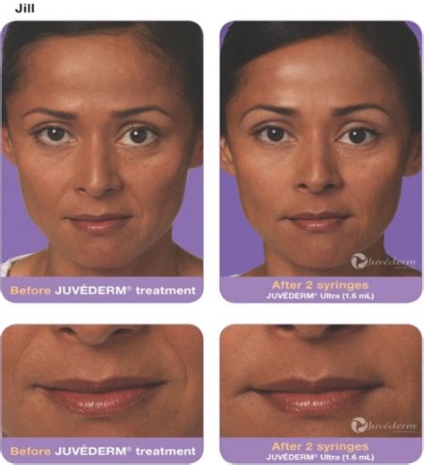 Juvederm Before and After Pictures - Velvet Effect Lasers