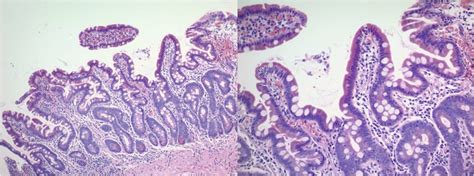 Duodenal Biopsies Reveal Recovery Of Normal Villous Architecture And A