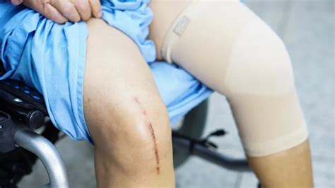 Bagaimana Perawatan Pra Dan Pasca Operasi Total Knee Replacement Ini