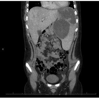 Repeat abdominal CT scan with contrast 6 days post abscess drainage:... | Download Scientific ...