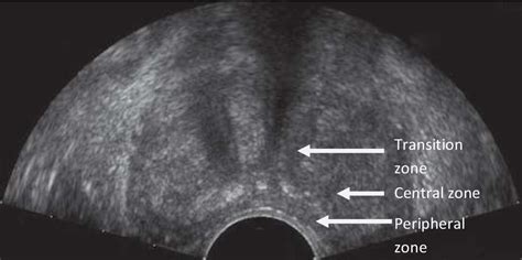 Prostate Anatomy Ultrasound