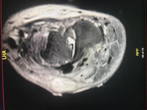 Figure Osteomyelitis Ct Scan Of Chronic Statpearls Ncbi Bookshelf