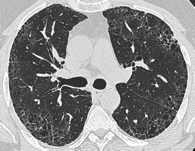 Pulmonary Fibrosis X Ray