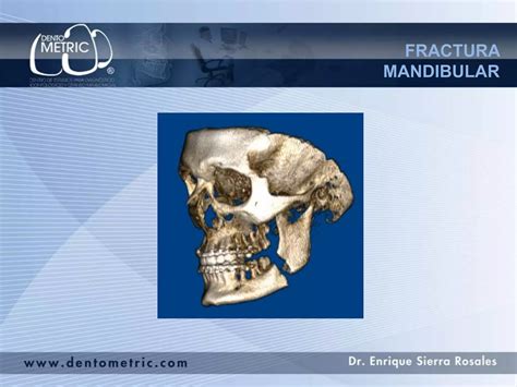 Fractura Mandibular PPT