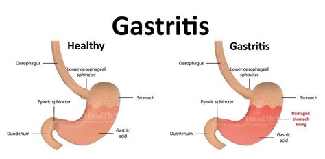 Gastritis