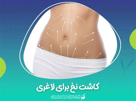 لاغری با امبدینگ طب سوزنی با نخ برای لاغری افزایش قد با طب سوزنی