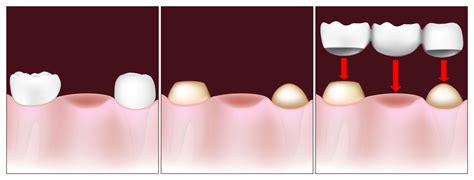 Traditional Bridges and Jawbone Health - Montreal, QC - Restorative Dentistry