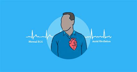 Atrial Fibrillation Explained