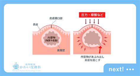 ずっと治らないできもの ？～粉瘤手術についてpart 1 成増駅前かわい皮膚科 地下鉄成増駅から徒歩5秒