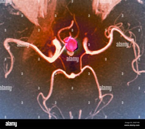 Cerebral Haemorrhage And Aneurysm Coloured Computed Tomography Ct