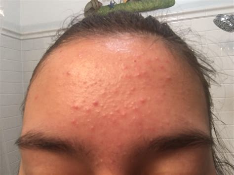 [skin concerns] have had really bad forehead acne for three months and ...