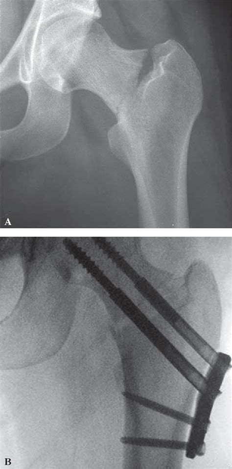 Figure 1 From Internal Fixation Of Femoral Neck Stress Fractures In