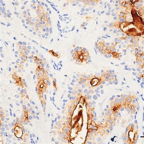 The Positive Staining Of P40 In Small Cells With Darkly Staining Nuclei