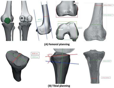 Applied Sciences Free Full Text Three Dimensional Printed Models In Pre Operative Planning