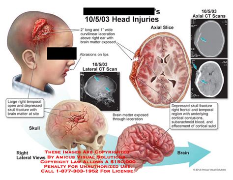 Head Injuries