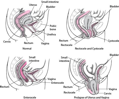 Pelvic Organ Prolapse Pop Women S Health Issues Merck Manuals Consumer Version Pélvica