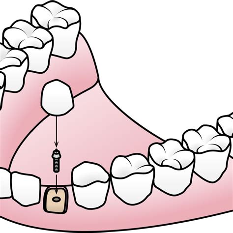 Endosteal Implants in Turlock, CA | Eggleston Dental Care