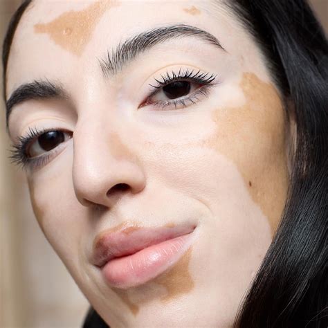 How To Care For Vitiligo Skin For A Natural And Confident Glow