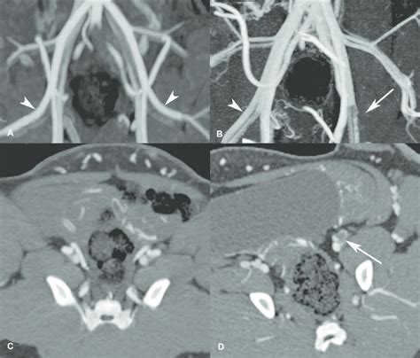 Occluded Left Femoral Artery After Application Of An 8f Angio Seal