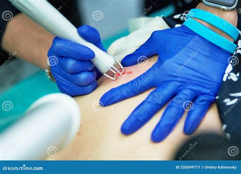 Laser Cosmetic Surgery And Skin Resurfacing In Dermatology Stock Image