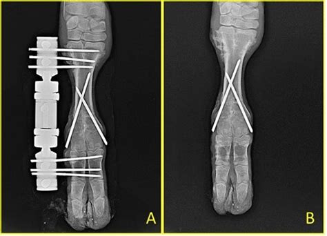 A: Radiographic view before dynamic axial external fixator removal ...