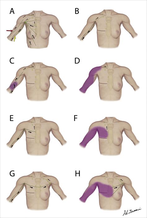 Schematic Diagram Lymphoedema Education Solutions