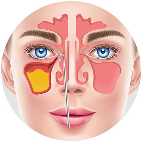sinus congestion diagram