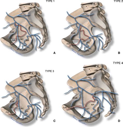 Pelvic Arterial Anatomy Relevant To Prostatic Artery Embolisation And